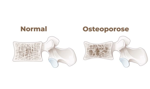 Pflanzenbasiert = Osteoporose-Risiko?